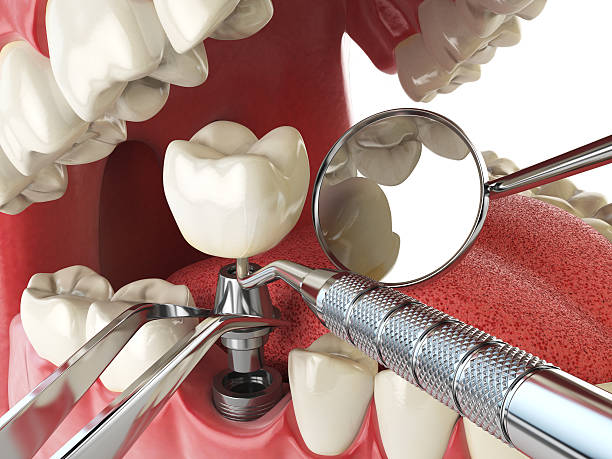 Best Chipped Tooth Repair Near Me  in Locust, NC